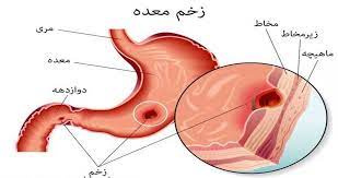 تحقیق معالجة زخم معده و روده