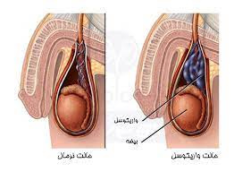 تحقیق پمفلت واریکوسل