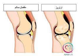 تحقیق آرتروز چیست و چگونه درمان می شود