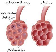 تحقیق ذات الریه (پنومونی)