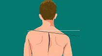 پاورپوینت ناهنجاری شانه نابرابر (uneven shoulder)