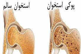 تحقیق پوکی استخوان