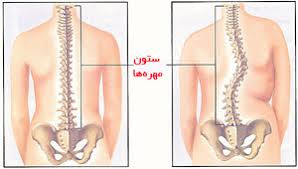 تحقیق اسكوليوز (انحناي‌ ستون‌ فقرات‌)