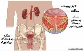 تحقیق بیماری پروستات