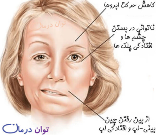 پاورپوینت فلج بل Bell’s Palsy به زبان انگلیسی