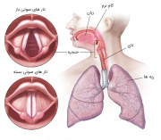 پاورپوینت التهاب حاد حنجره نای و نایژه