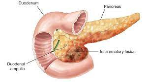 پاورپوینت پانکراتیت Pancreatitis