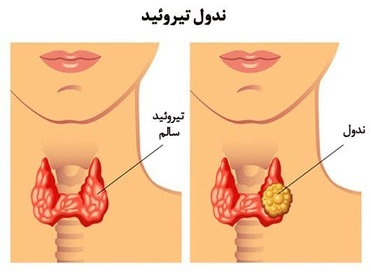 پاورپوینت پرکاری تيروئيد