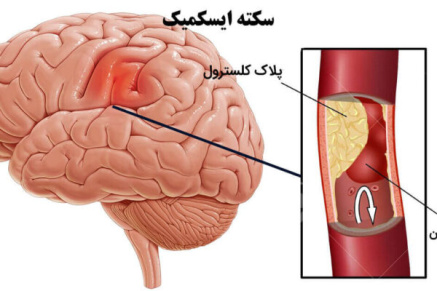 پاورپوینت آسیبهای عروقی مغز