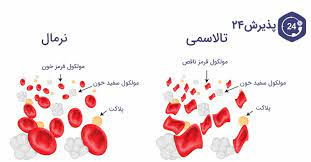 پاورپوینت بررسی شیوع انواع مختلف تغییرات در ژن آلفا هموگلوبین در بیماران مبتلا به تالاسمی آلفا