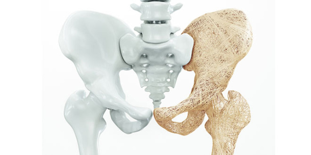 پاورپوینت پوکی استخوان Osteoporosis