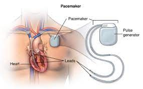 پاورپوینت پيس ميكر یا pacemaker