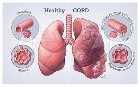 پاورپوینت بیماریهای مزمن انسدادی ریه COPD