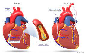 پاورپوینت پیوند عروق خونی ( CABG )