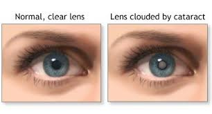 تحقیق آب‌ مرواريد cataract