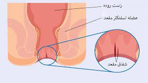 تحقیق شقاق‌ مقعد