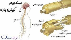 پاورپوینت سندرم گیلن باره