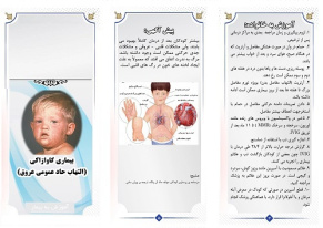 پمفلت بیماری کاوازاکی (برشور سندرم کاوازاکی Kawasaki syndrome)