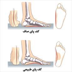 تحقیق بررسی کف پای صاف Foot pes plane