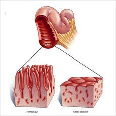 تحقیق درمورد بیماری سلیاک