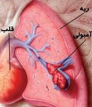 امبولی ریه چیست ؟ و چه خطرهایی دارد