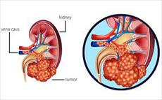 تومورهای کلیه و مثانه و بیماری های انسدادی