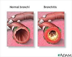 پاورپوینت بیماری COPD