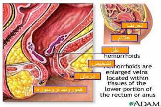 پاورپوینت بررسی هموروئید (بواسیر)