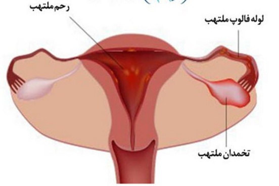 پاورپوینت التهاب لگن در زنان