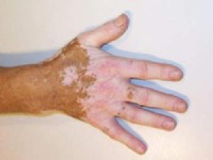 سیستم خبره تشخیص بیماری های پوستی