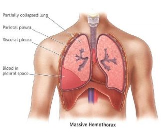 پاورپوینت درسی ترومای قفسه سینه (chest trauma)